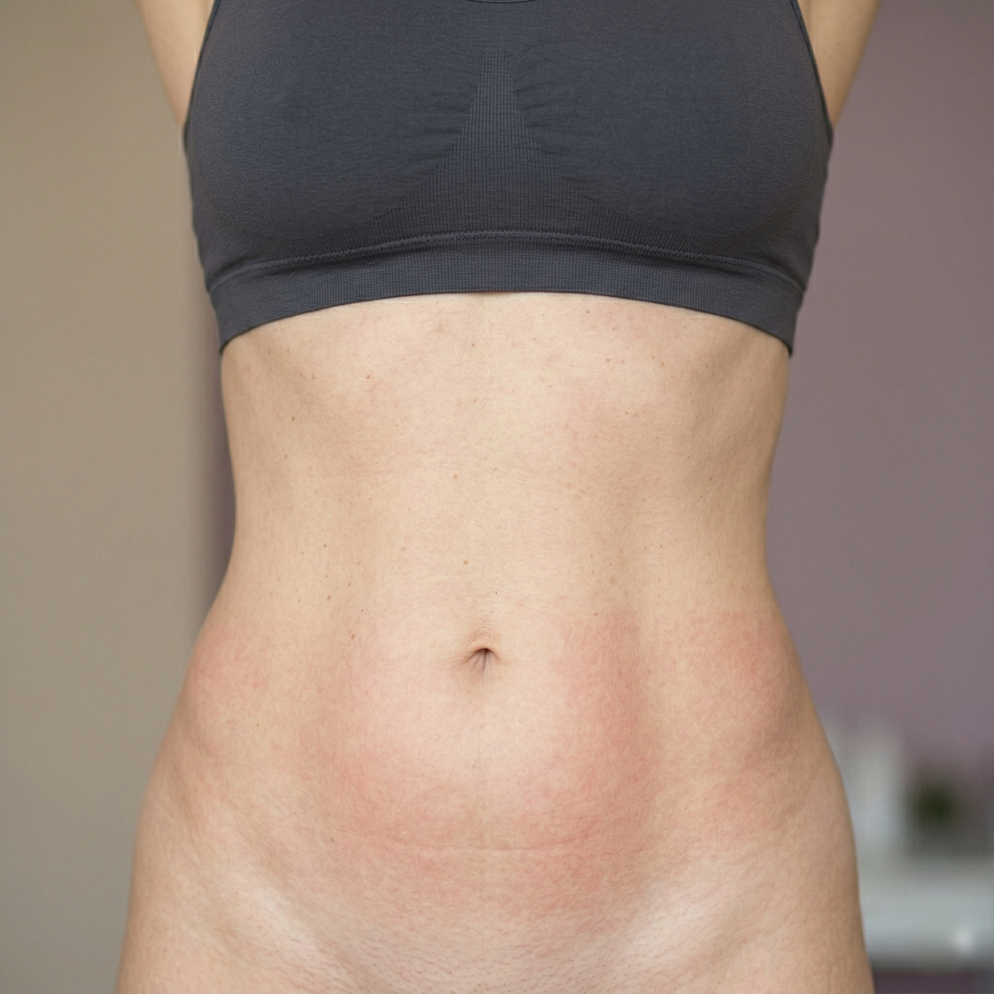 Kryolipolyse After