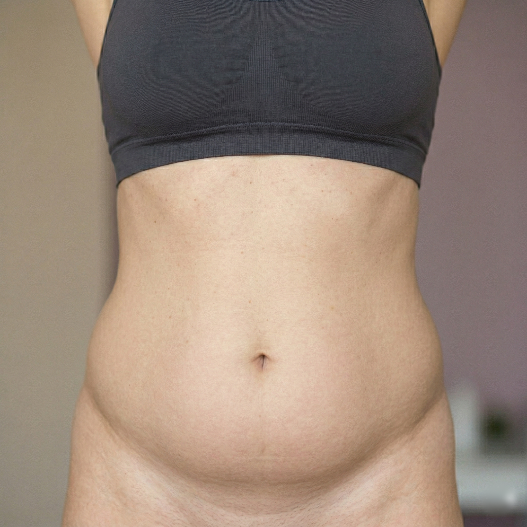 Kryolipolyse Before